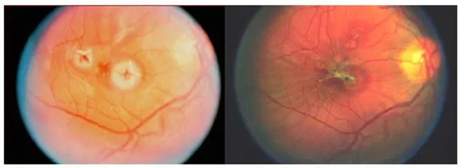 Darstellung einer Augenschädigung durch Laser